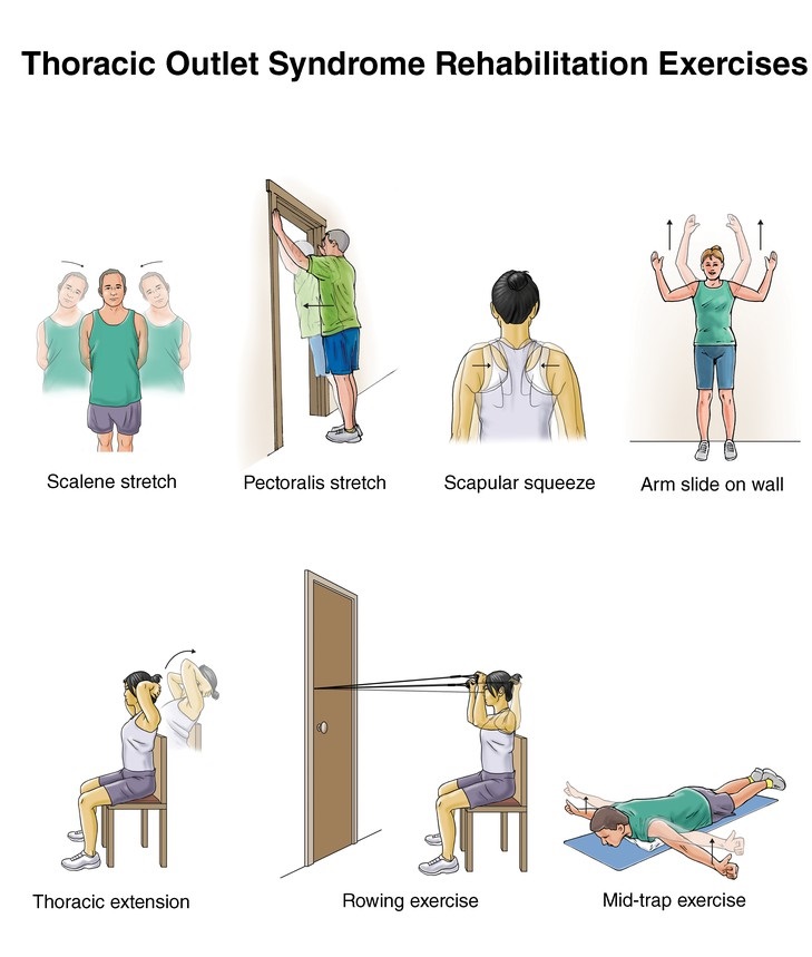 دنده گردنی , دنده اضافی ,  گردن درد , TOS, ورزش گردن , TOS exercises